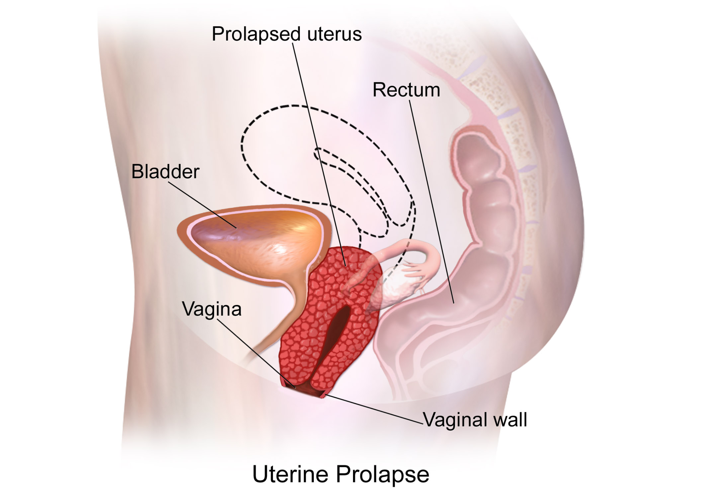 Can Prolapse Get Better Naturally? What the Research Says About Non-Surgical Support